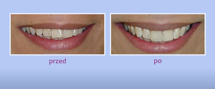 Przed i po - leczenie stomatologiczne