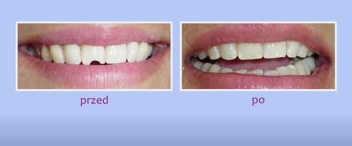 Przed i po - leczenie stomatologiczne
