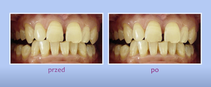 Przed i po - leczenie stomatologiczne